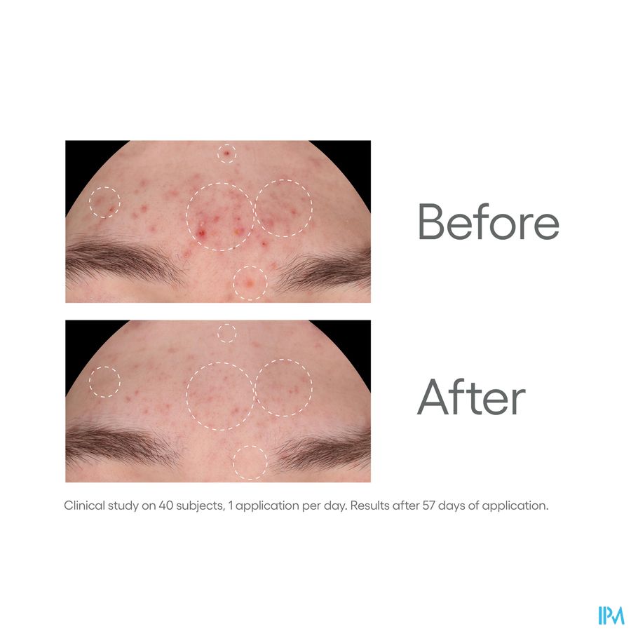 A-DERMA  BIOLOGY AC NIGHT-PEEL Sérum anti-imperfections - Effet peau neuve - Points noirs, acné