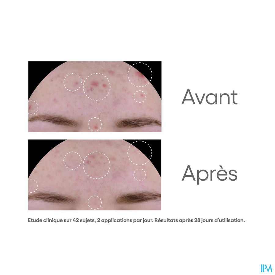 A-DERMA BIOLOGY AC GLOBAL - Crème hydratante visage anti-imperfections, anti-marques, acné