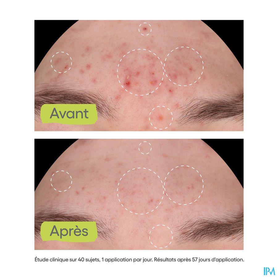 A-DERMA  BIOLOGY AC NIGHT-PEEL Sérum anti-imperfections - Effet peau neuve - Points noirs, acné